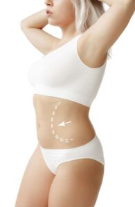 Lipoabdominoplastia En Bogot Logre Un Abodmen Perfecto