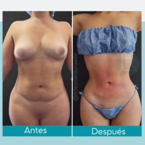 Liposucción antes y después