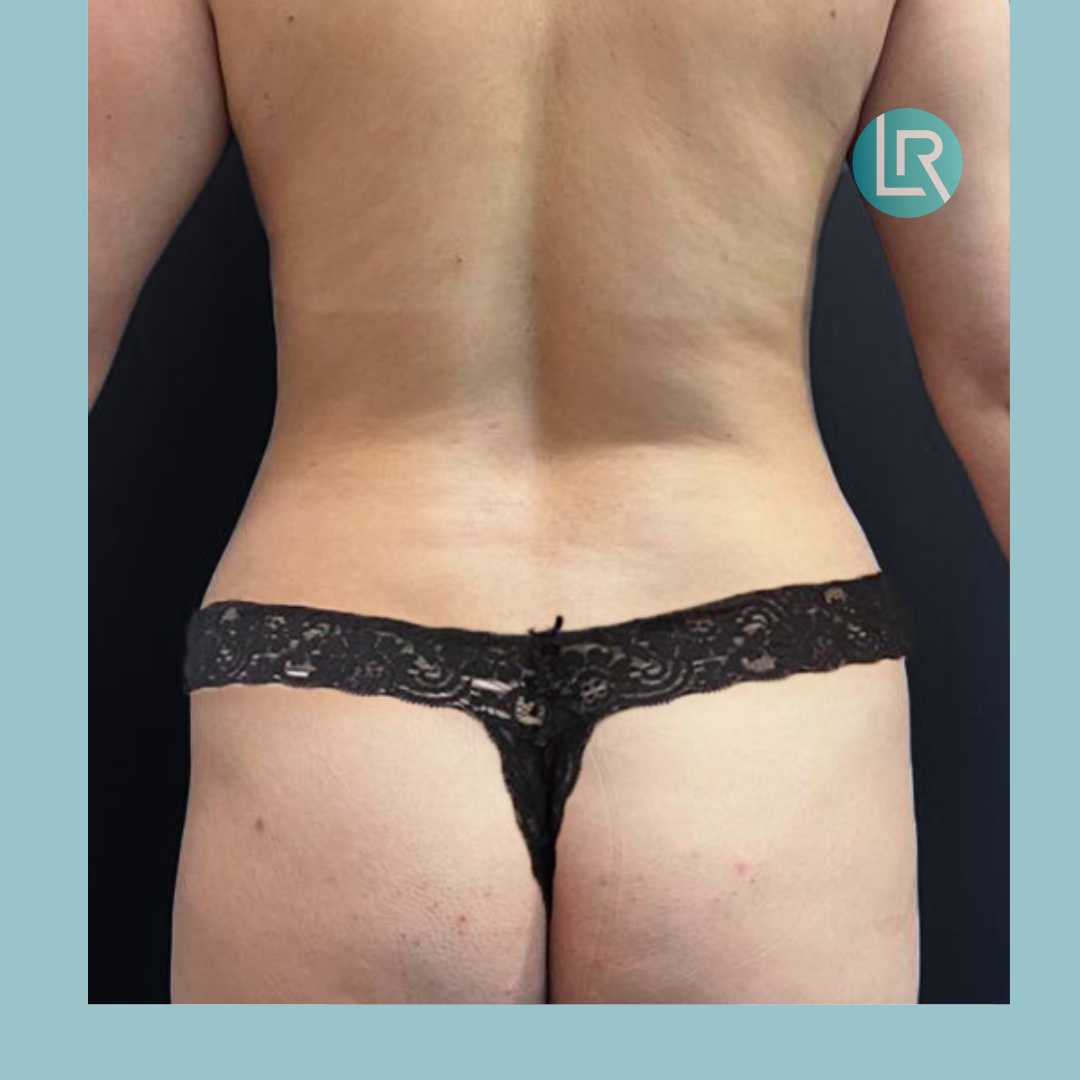 Liposucción + mastopexia