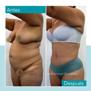 Lipoabdominoplastia
