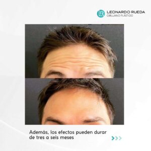 Caso 2 antes y después Toxina Botulínica, Dr. Leonardo Rueda, Cirujano Plástico