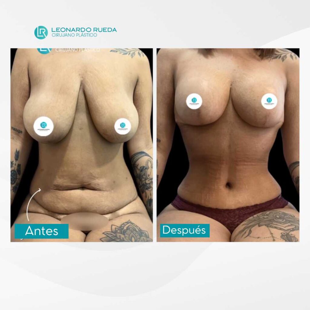 Abdominoplastia y Pexia Mamaria fotos