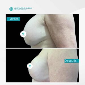 Explantación mamaria antes y después (2)