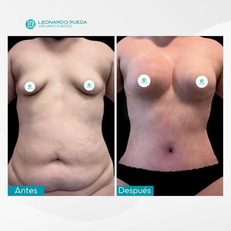 Liposucción y mamoplastia fotos (4)