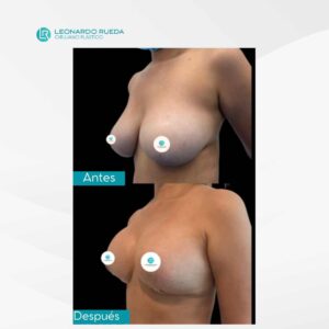 Pexia mamaria antes y después (3)