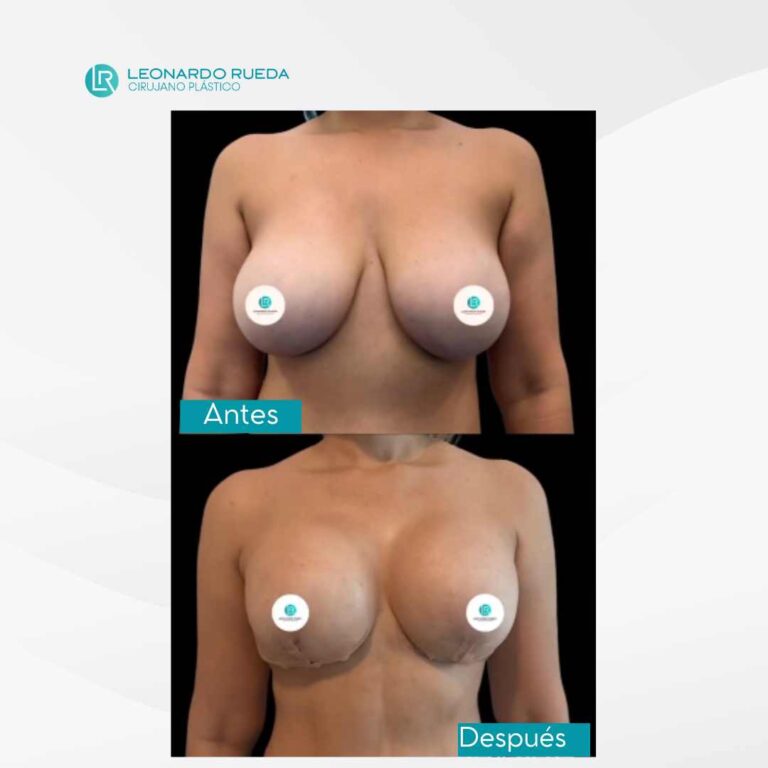 Pexia mamaria antes y después