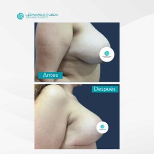 Reducción mamaria antes y después (2)