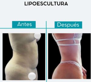 Antes y después lipoescultura - Dr. Leonardo Rueda