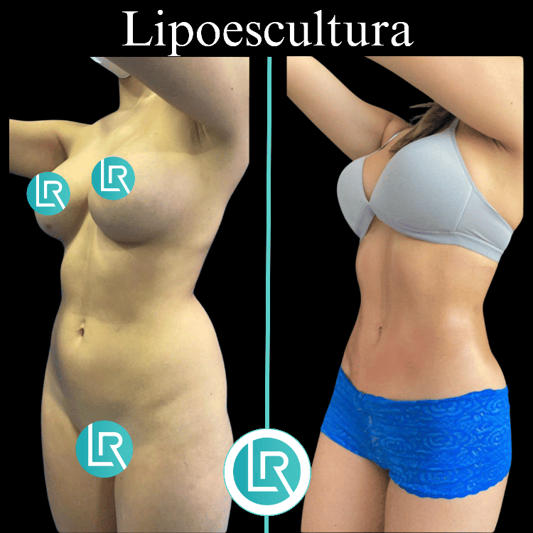 Lipoescultura Dr Leonardo Rueda