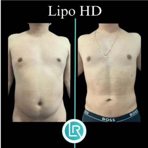 Lipo HD Dr Leonardo Rueda