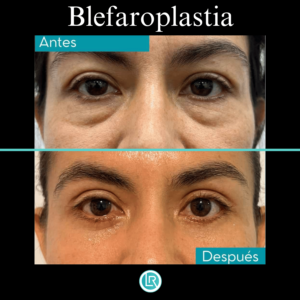 Blefaroplastia antes y después