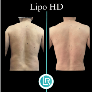 Lipo HD Dr Leonardo Rueda