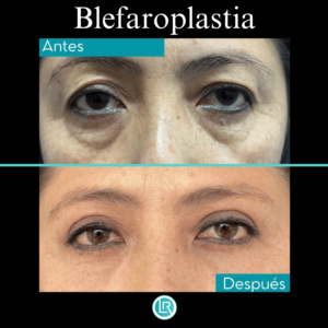 Blefaroplastia Dr Leonardo Rueda