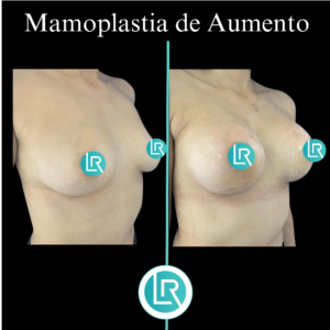 Mamoplastia de Aumento Dr Leonardo Rueda