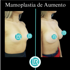 Mamoplastia de Aumento Dr Leonardo Rueda