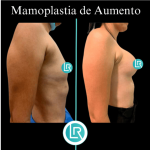 Mamoplastia de Aumento Dr Leonardo Rueda