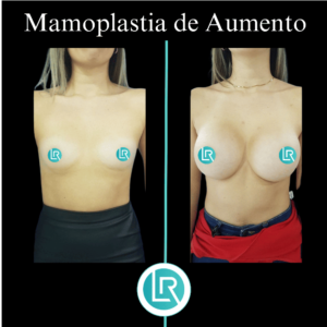 Mamoplastia de Aumento Dr Leonardo Rueda