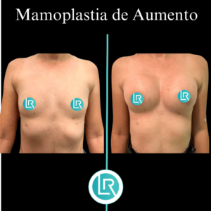 Mamoplastia de Aumento Dr Leonardo Rueda