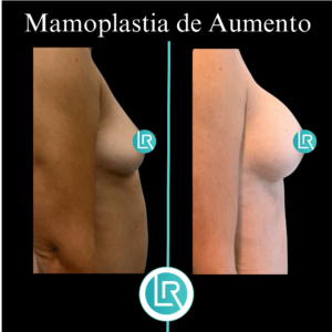 Mamoplastia de Aumento Dr Leonardo Rueda