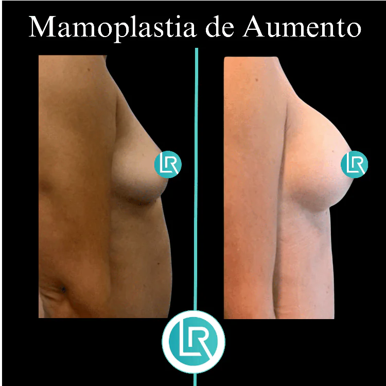 Mamoplastia de Aumento Dr Leonardo Rueda