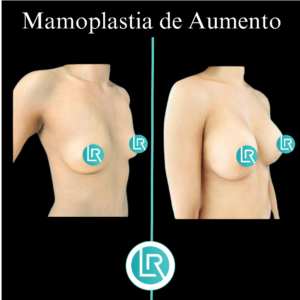 Mamoplastia de Aumento Dr Leonardo Rueda