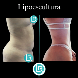 Lipoescultura Dr Leonardo Rueda