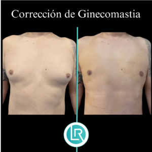Correccion de Ginecomastia Dr Leonardo Rueda