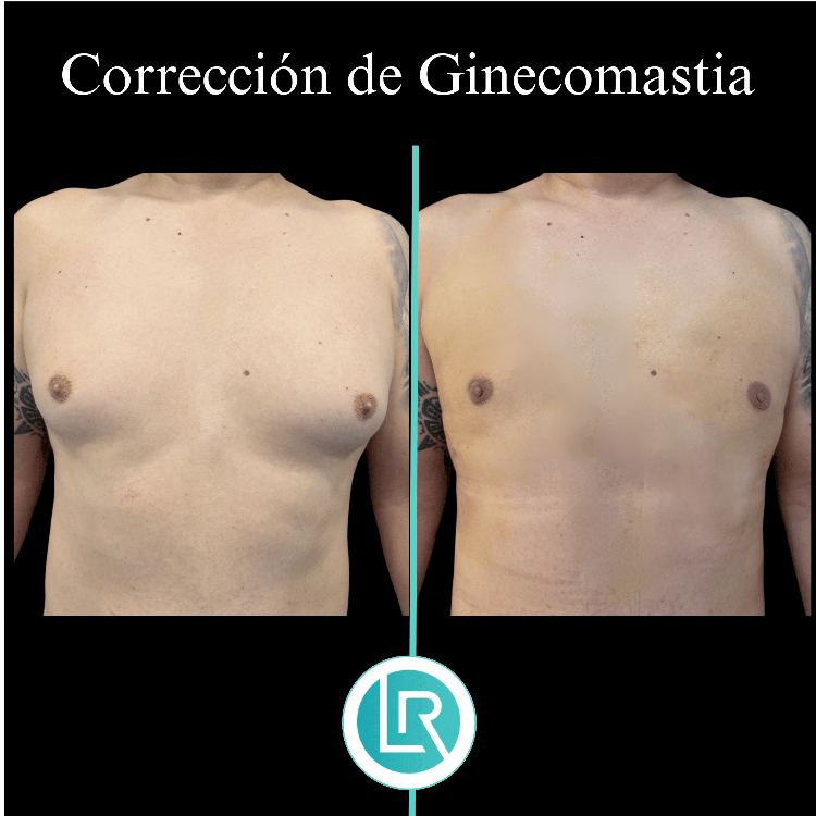 Correccion de Ginecomastia Dr Leonardo Rueda