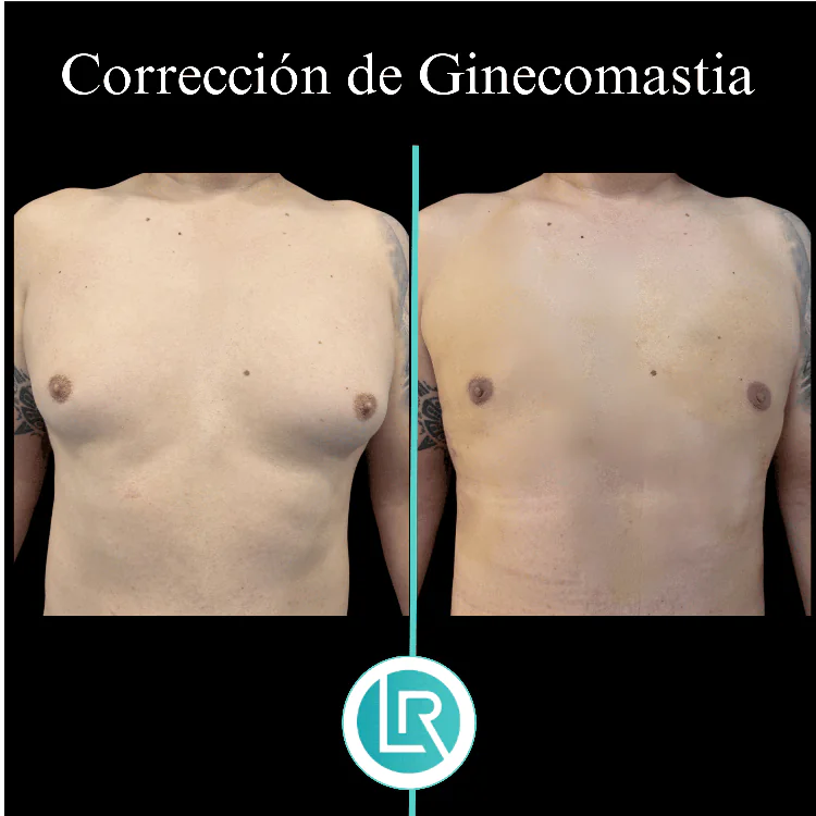 Correccion de Ginecomastia Dr Leonardo Rueda