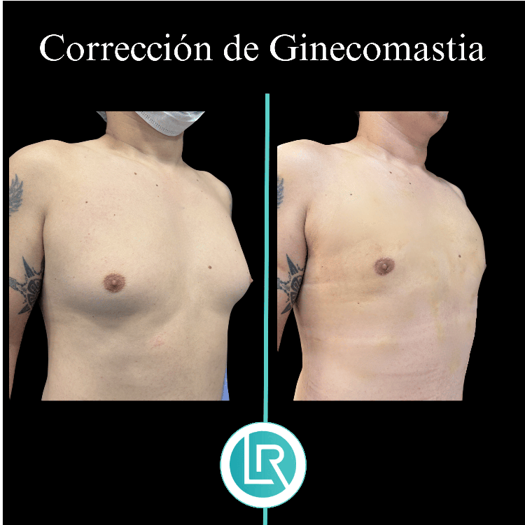 Correccion de Ginecomastia Dr Leonardo Rueda