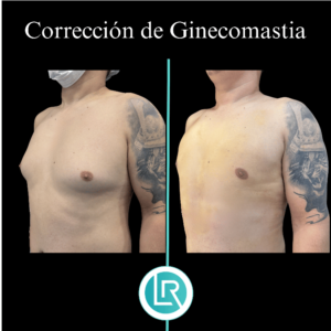 Correccion de Ginecomastia Dr Leonardo Rueda