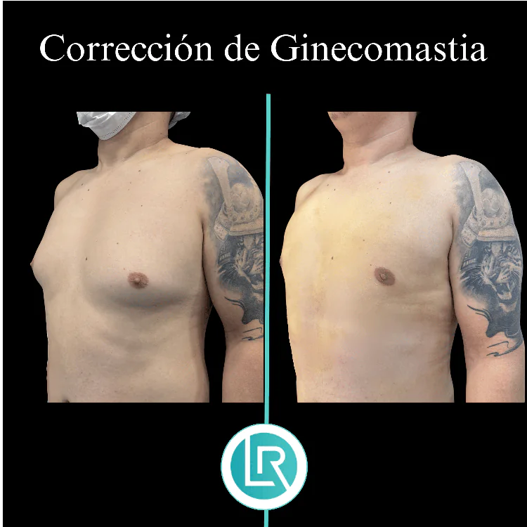 Correccion de Ginecomastia Dr Leonardo Rueda