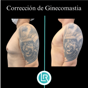 Correccion de Ginecomastia Dr Leonardo Rueda