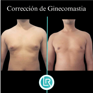 Correccion de Ginecomastia Dr Leonardo Rueda