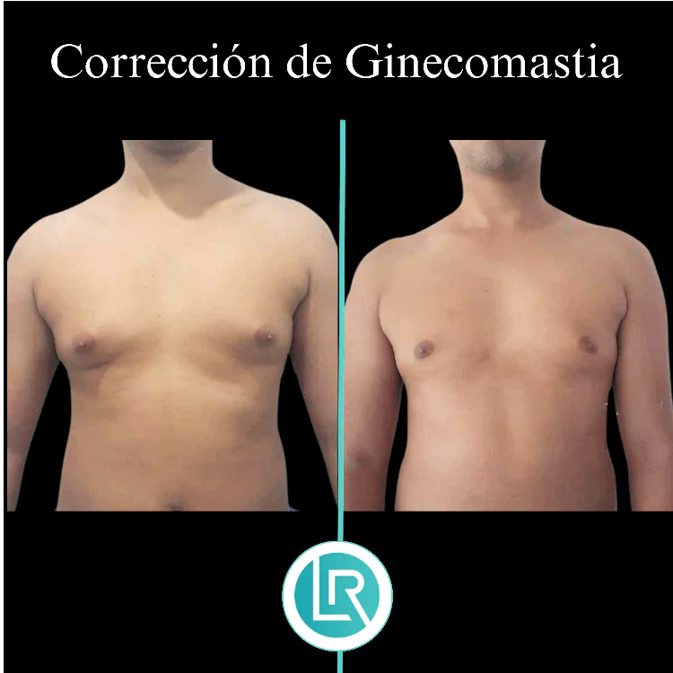 Correccion de Ginecomastia Dr Leonardo Rueda