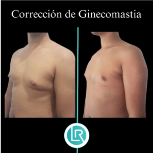 Correccion de Ginecomastia Dr Leonardo Rueda