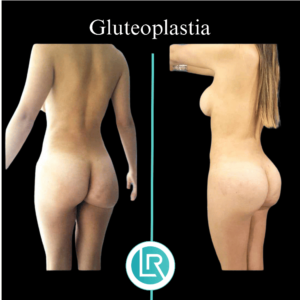 Gluteoplastia Dr Leonardo Rueda