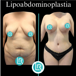 Lipoabdominoplastia Dr Leonardo Rueda
