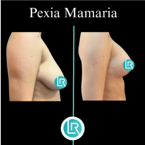 Pexia Mamaria Dr Leonardo Rueda