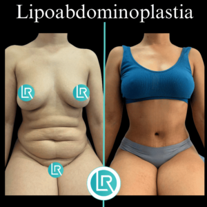 Lipoabdominoplastia Dr Leonardo Rueda