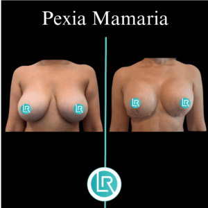 Pexia Mamaria Dr Leonardo Rueda