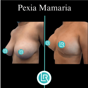 Pexia Mamaria Dr Leonardo Rueda