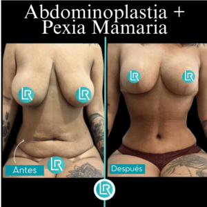 Cirugia Contorno Corporal Dr Leonardo Rueda