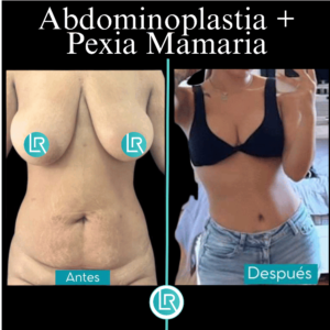 Cirugia Contorno Corporal Dr Leonardo Rueda