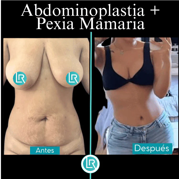 Cirugia Contorno Corporal Dr Leonardo Rueda