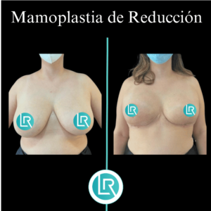 Mamoplastia de Reduccion Dr Leonardo Rueda