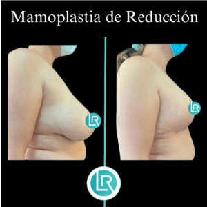 Mamoplastia de Reduccion Dr Leonardo Rueda