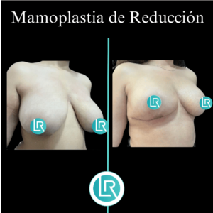 Mamoplastia de Reduccion Dr Leonardo Rueda