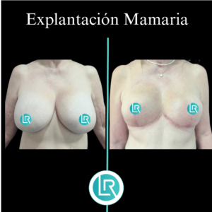 Explantacion Mamaria Dr Leonardo Rueda