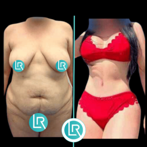 Lipectomía + Mamoplastia